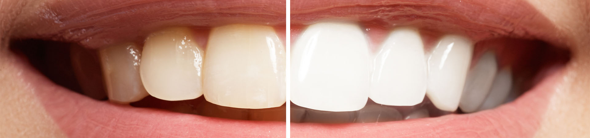 How Much Do Veneers Cost 5 Factors Included In The Price 3179